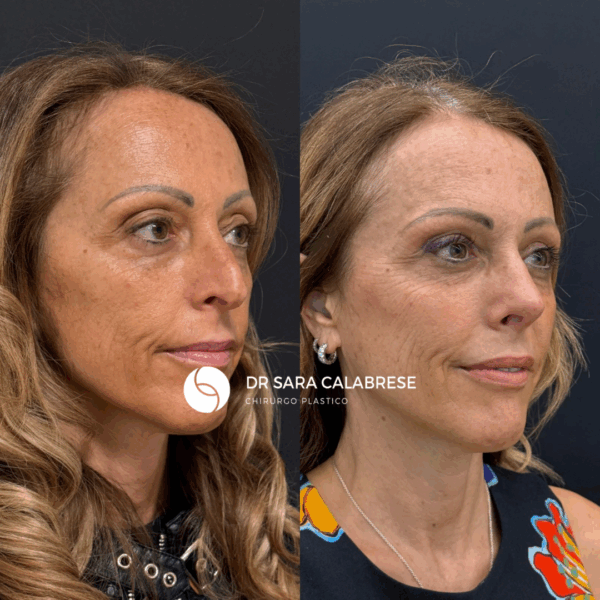 Blefaroplastica completa