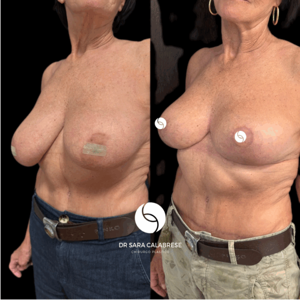 Mastoplastica riduttiva