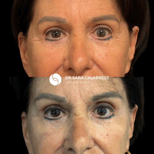 Lifting temporale del sopracciglio